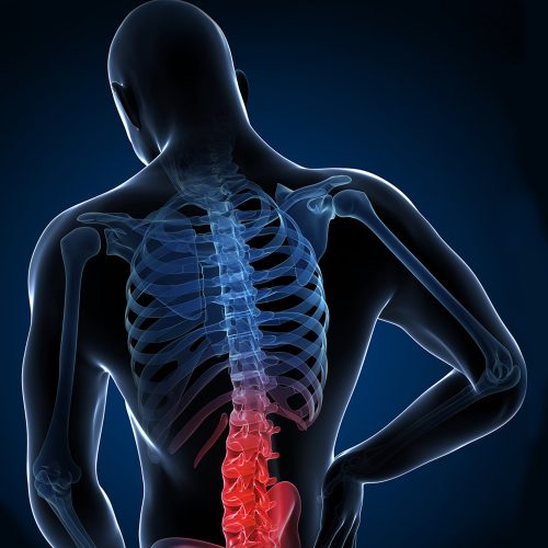 Beating Ankylosing Spondylitis Naturally